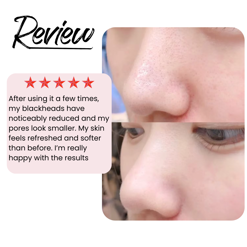 Ultrasonic Skin Scrubber – Deep Cleansing & Blackheads Remover