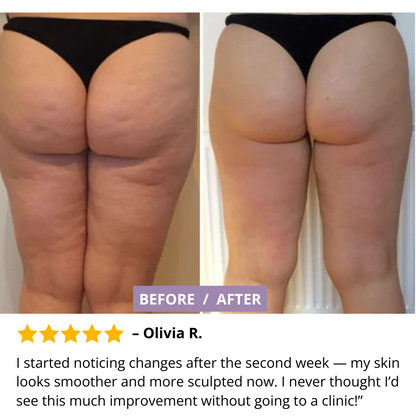 Vacuum Slimming Massager – Cellulite Reduction & Skin Firming