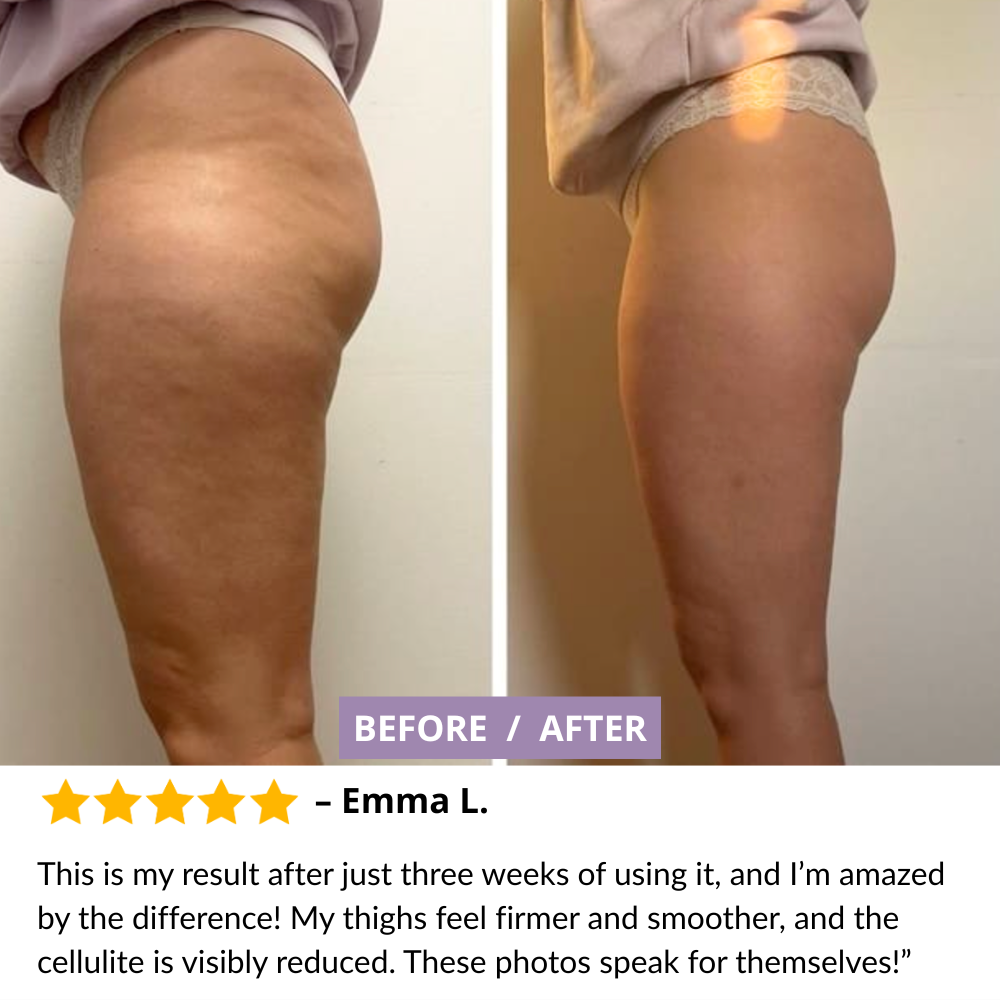 Vacuum Slimming Massager – Cellulite Reduction & Skin Firming