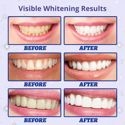 5D Teeth Whitening Strips – Professional Results at Home