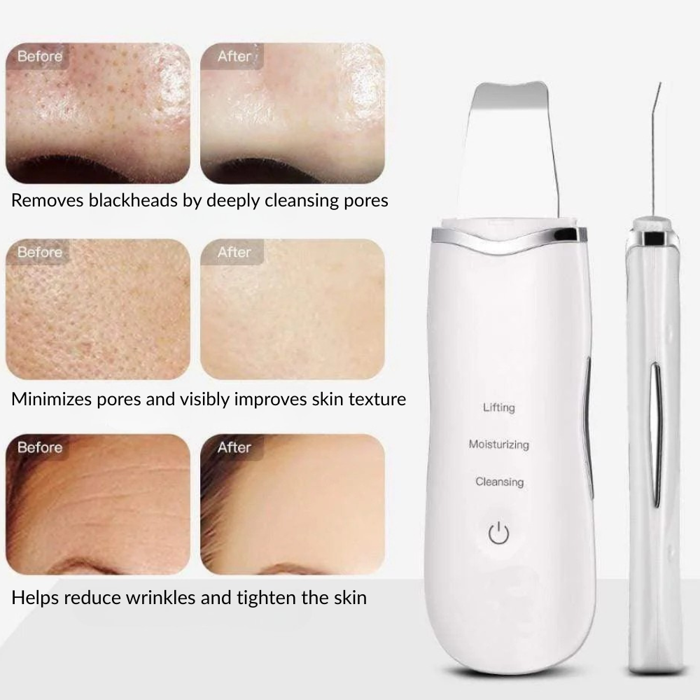 Ultrasonic Skin Scrubber – Deep Cleansing & Blackheads Remover