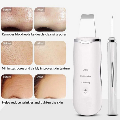Ultrasonic Skin Scrubber – Deep Cleansing & Blackheads Remover